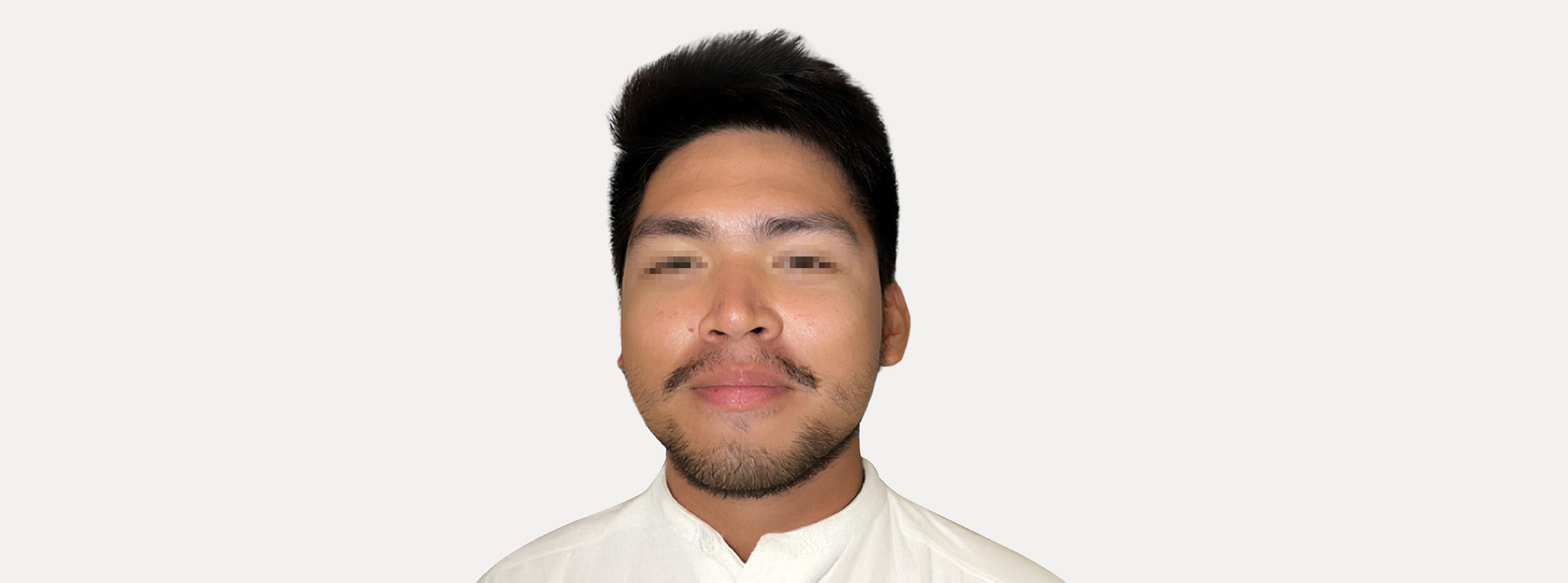 Rostro de un hombre con bigote y barba antes de recibir depilación láser facial.