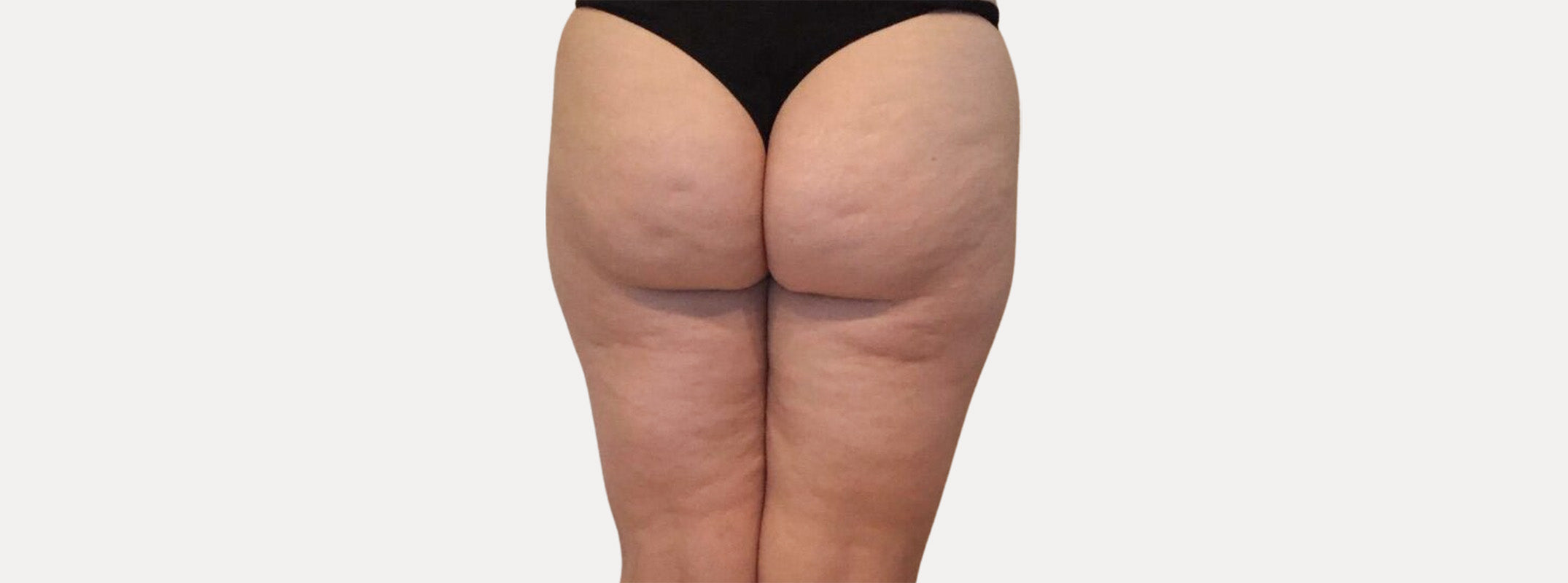 Glúteos de una mujer antes de pasar por el tratamiento de subsición para celulitis.