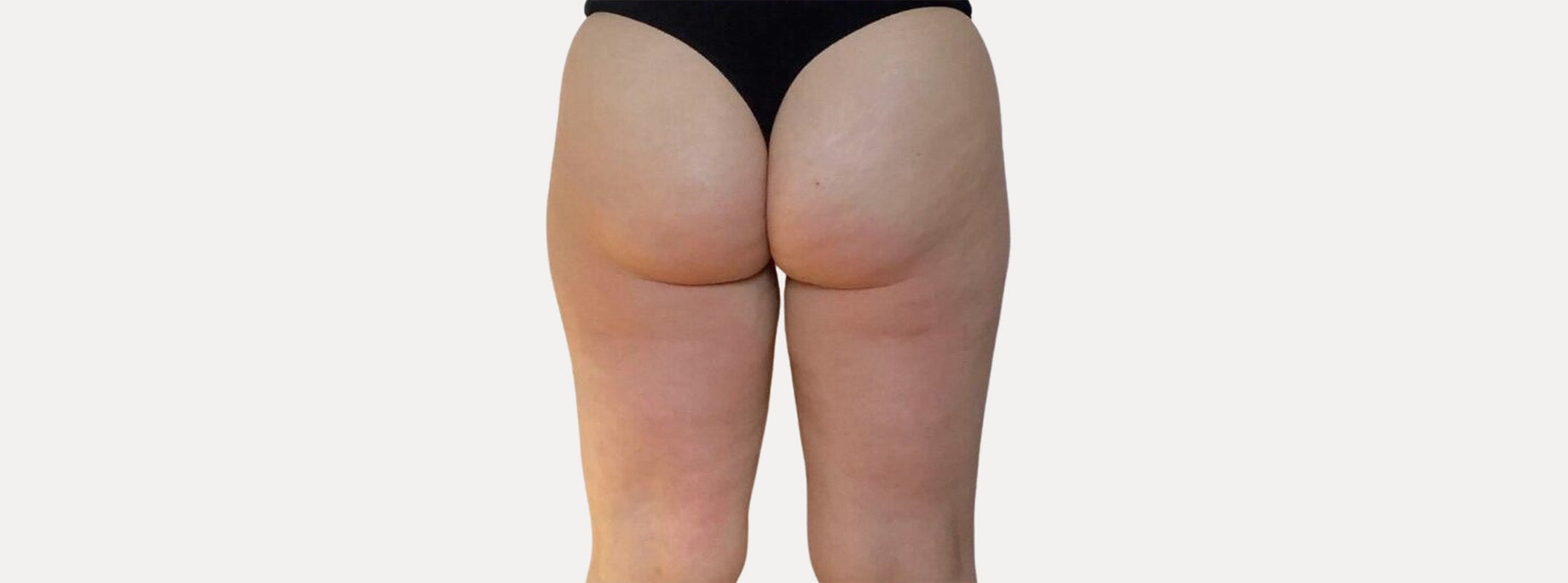 Glúteos de una mujer después de pasar por el tratamiento de subsición para celulitis.