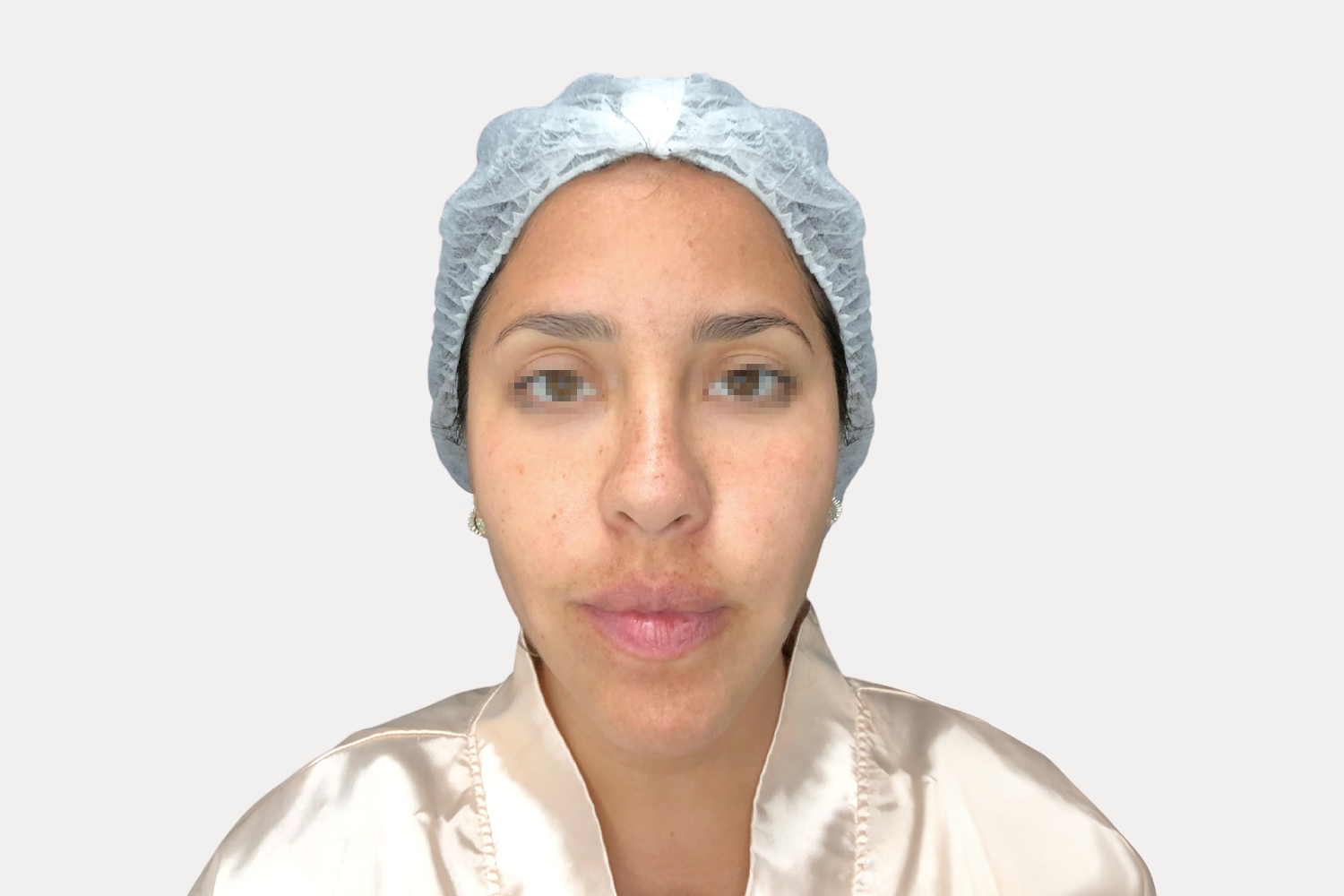 Biorevitalizador