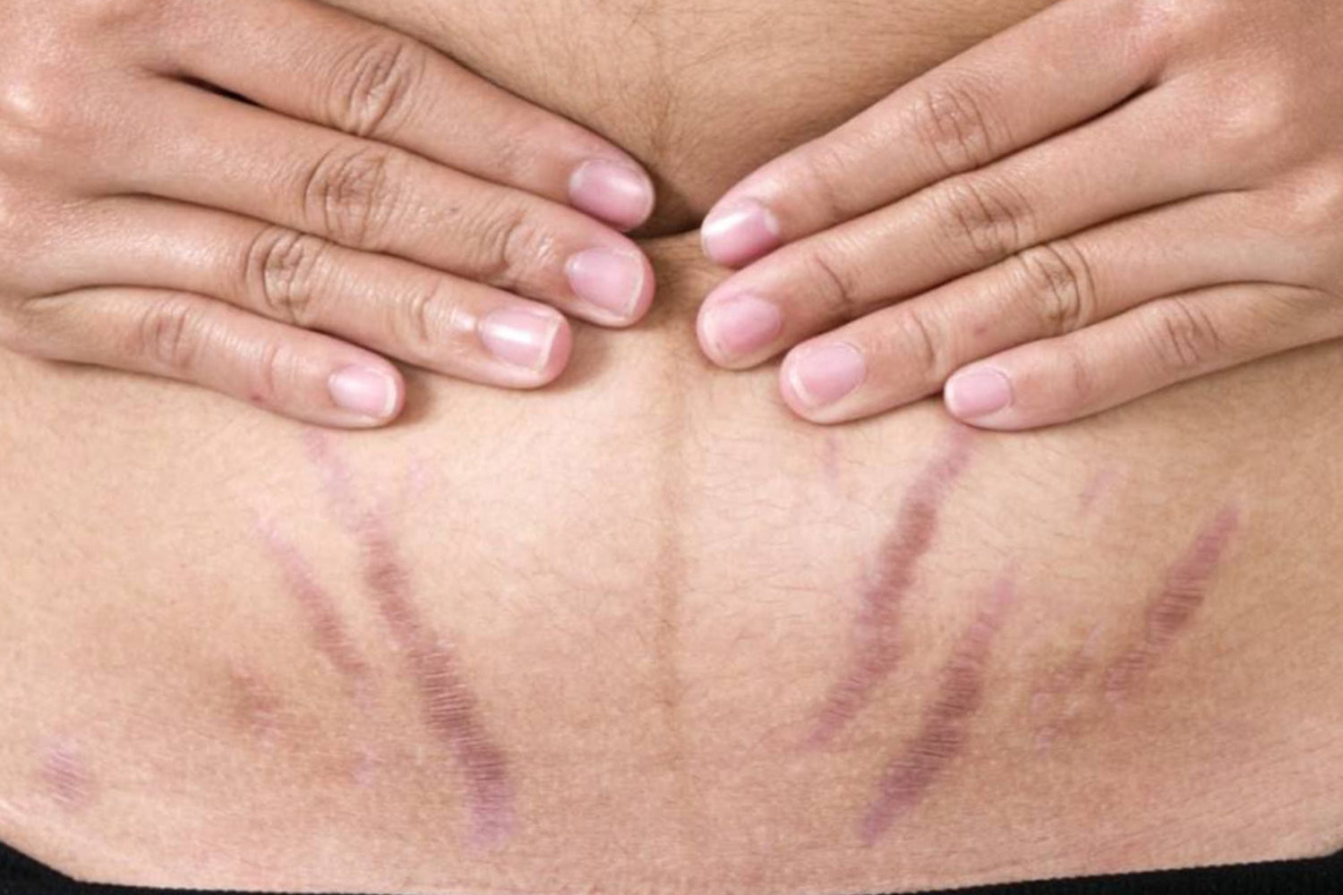Foto muestra un abdomen con estrias