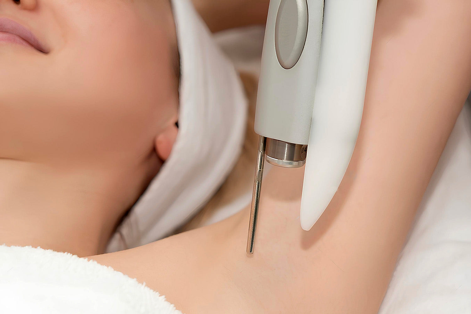 Depilación Despigmentacion De Axilas Con Laser Tratamiento Laser