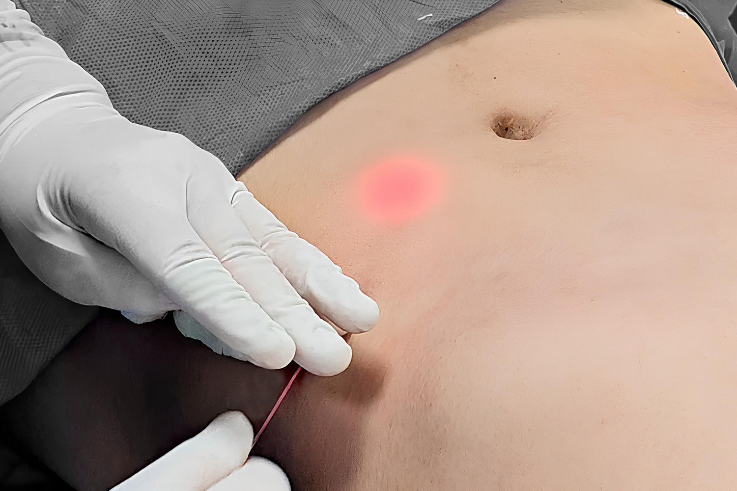 Acercamiento del abdomen de una persona recibiendo un tratamiento láser.