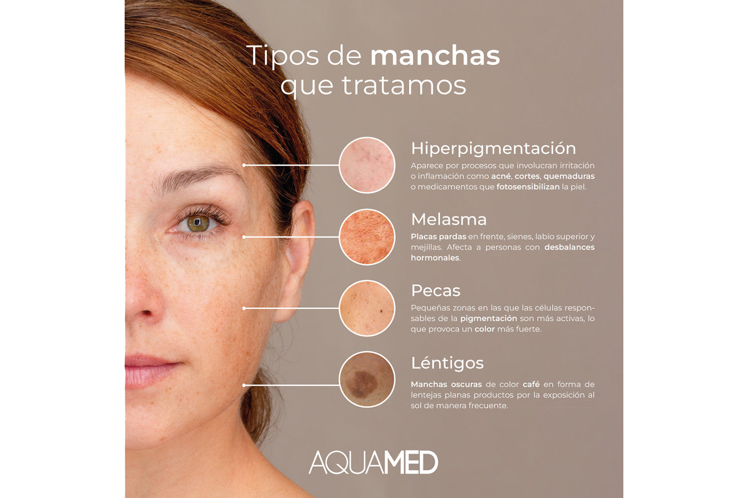 Infografía sobre los "Tipos de manchas que tratamos": Hiperpigmentación, Melasma, Pecas y Léntigos.