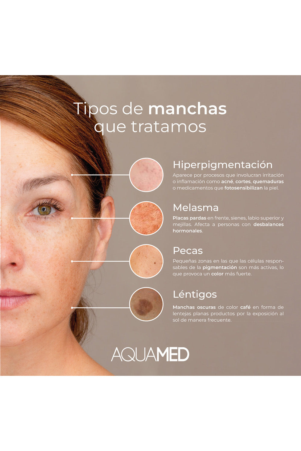 Infografía sobre los "Tipos de manchas que tratamos": Hiperpigmentación, Melasma, Pecas y Léntigos.