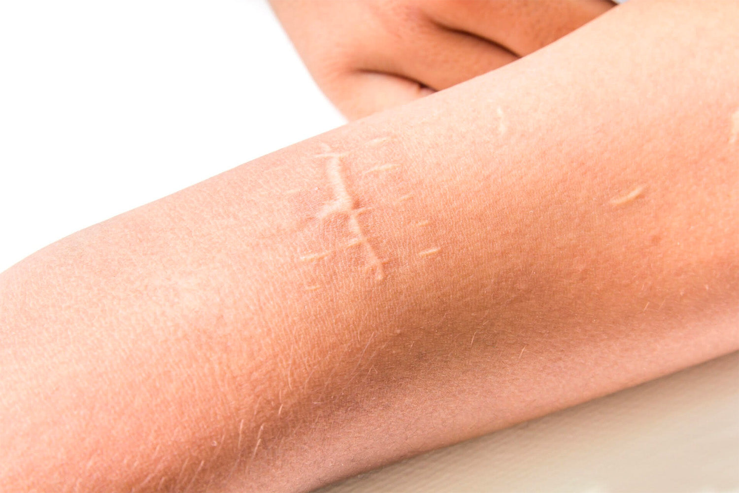 Acercamiento de una cicatriz en el brazo de una persona.