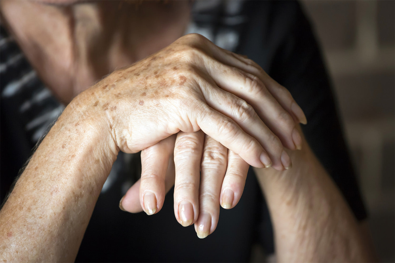 Acercamiento a las manos con léntigos solares de una persona de la tercera edad.
