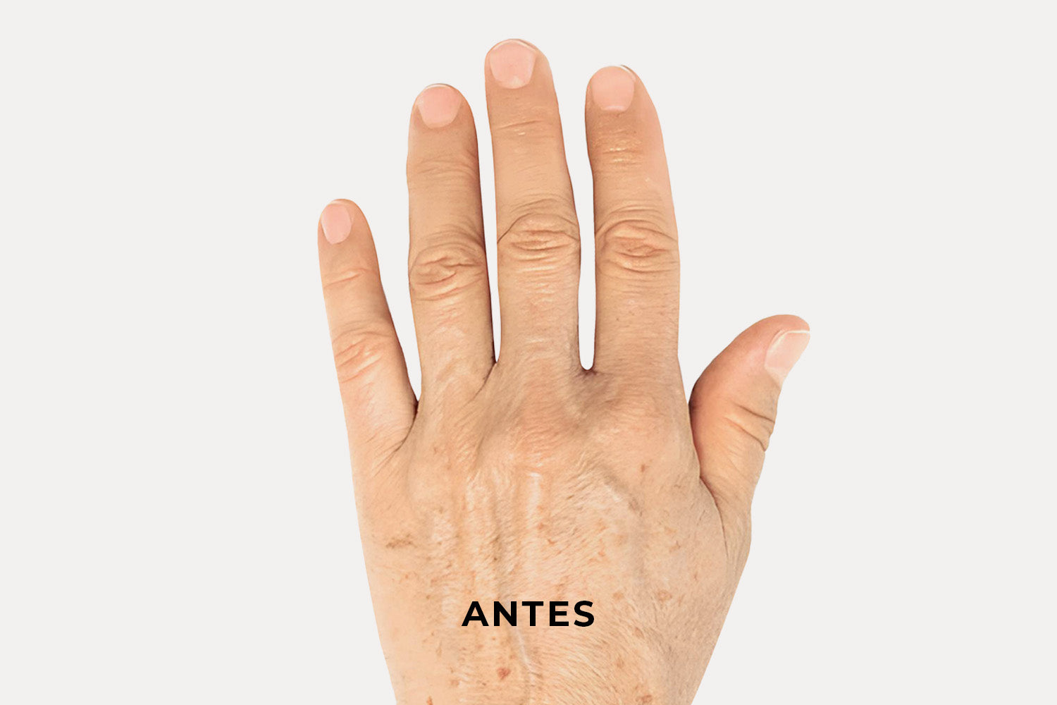 Acercamiento de una mano con léntigos solares que tiene la palabra "Antes" sobre la imagen.