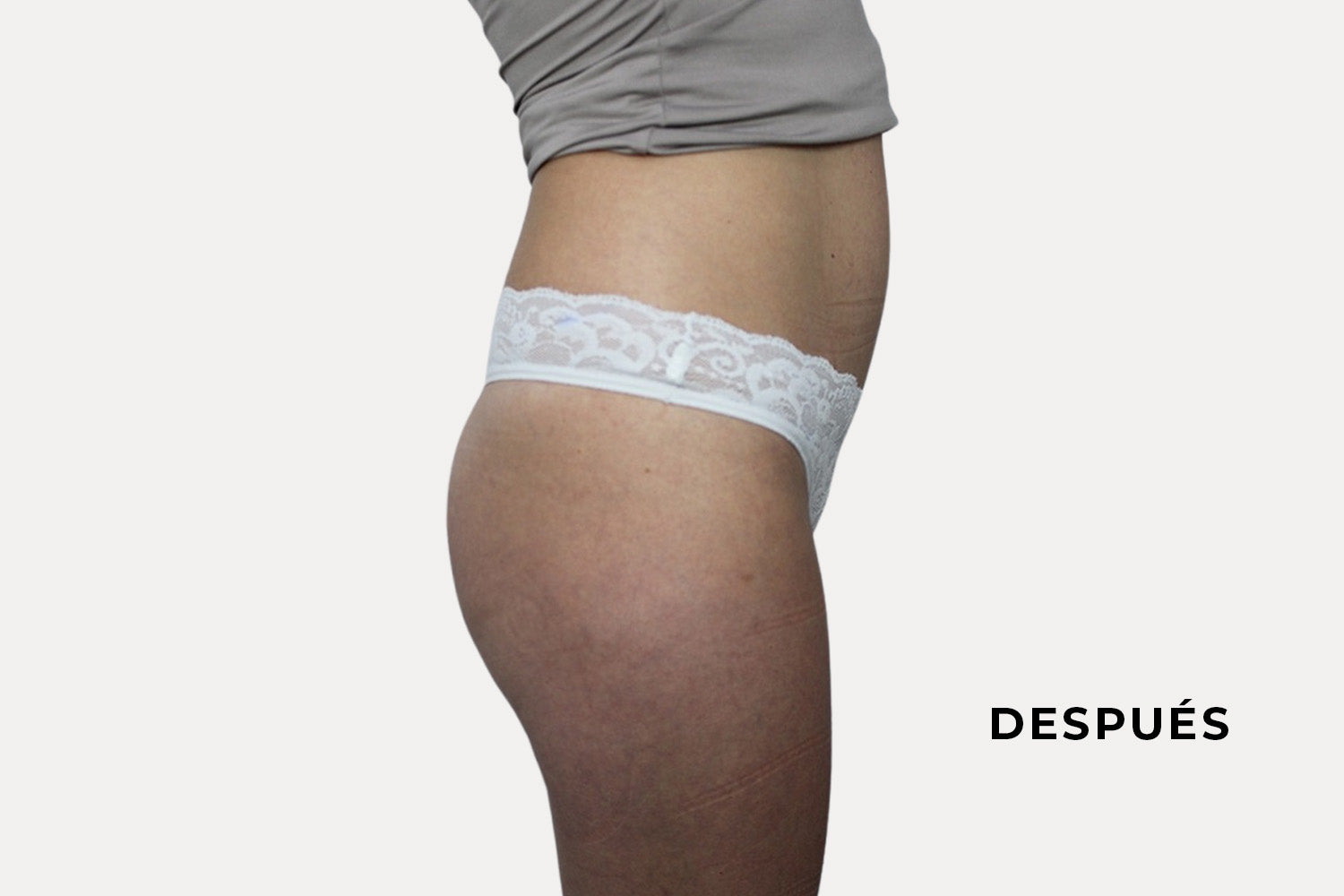 Glúteos de una mujer después de pasar por el tratamiento de quick muscle.