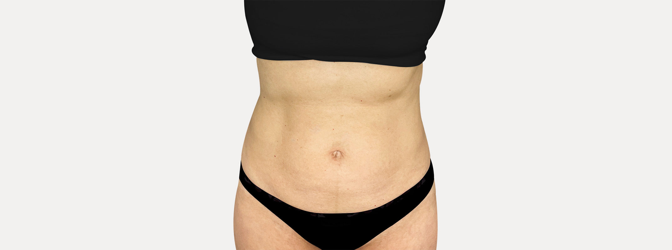 Abdomen de una mujer antes de pasar por el tratamiento Smartlifting RF.