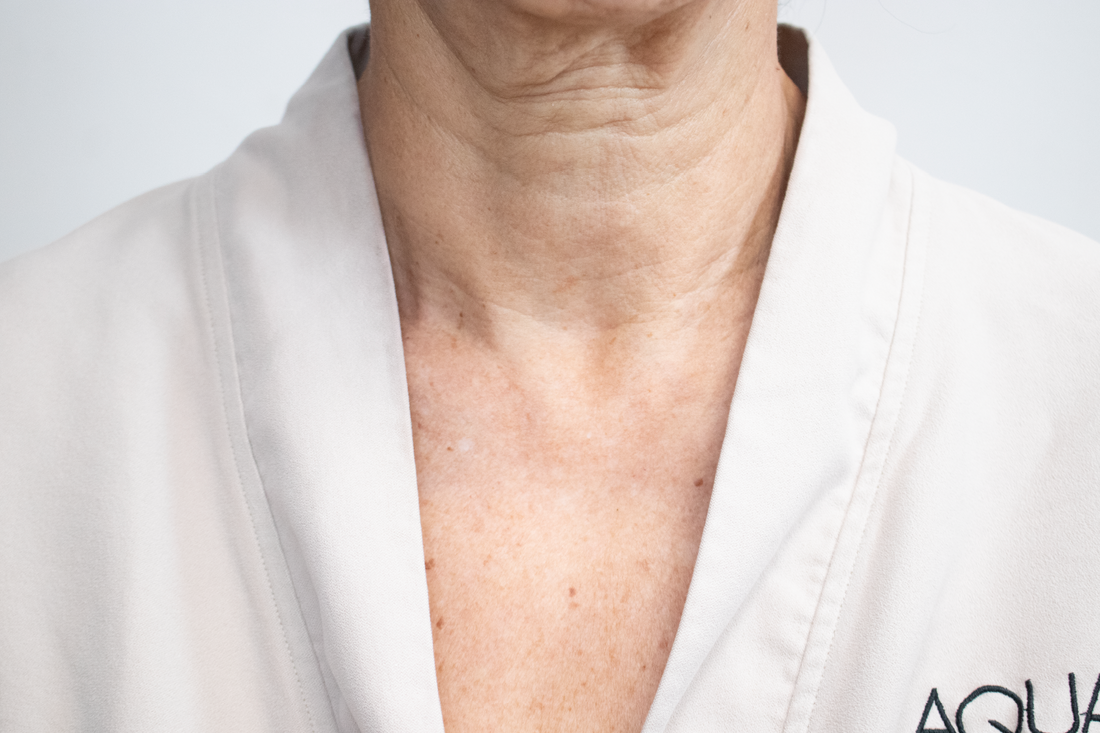 Evolift Láser CO2 Cuello o escote