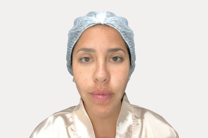 Biorevitalizador