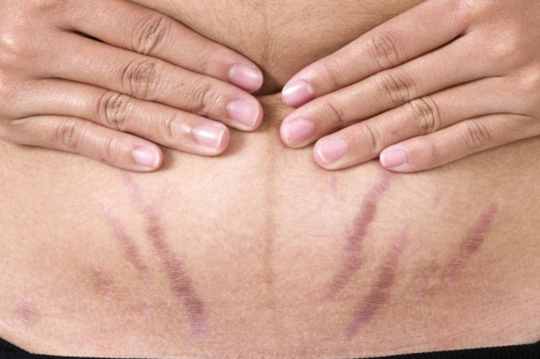 Foto muestra un abdomen con estrias