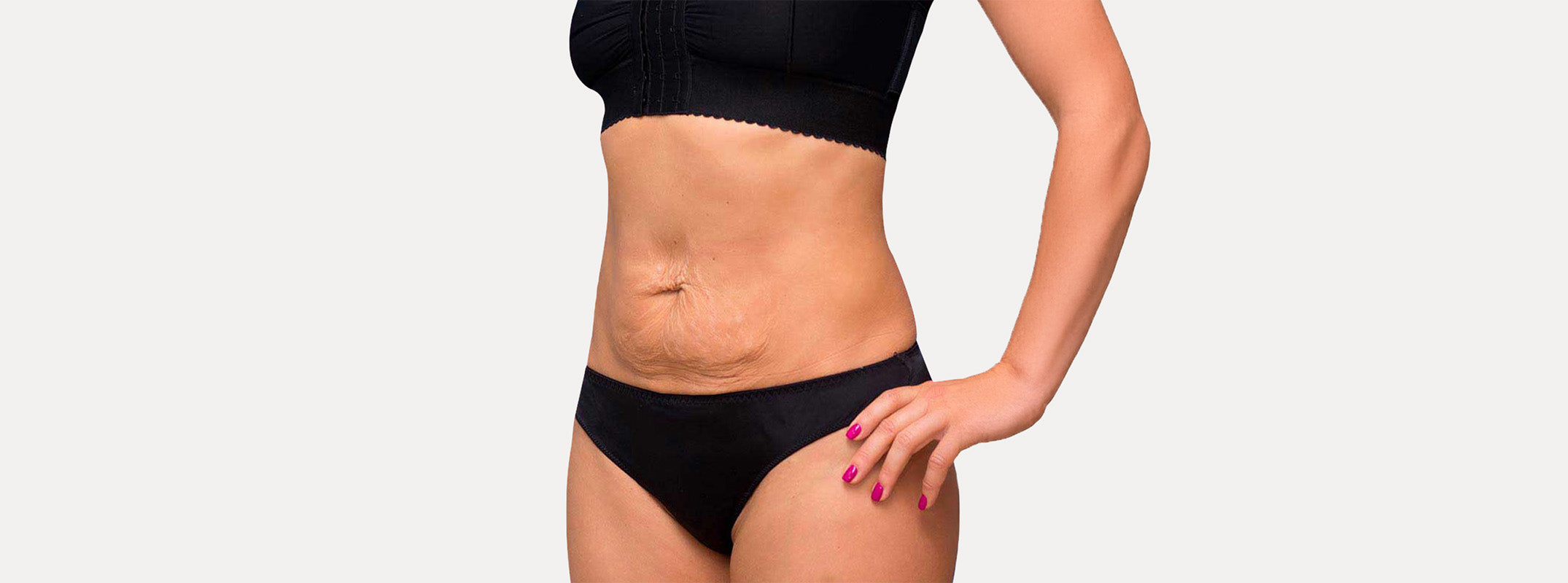 Abdomen de una mujer antes de pasar por el tratamiento Afrodita Skin.