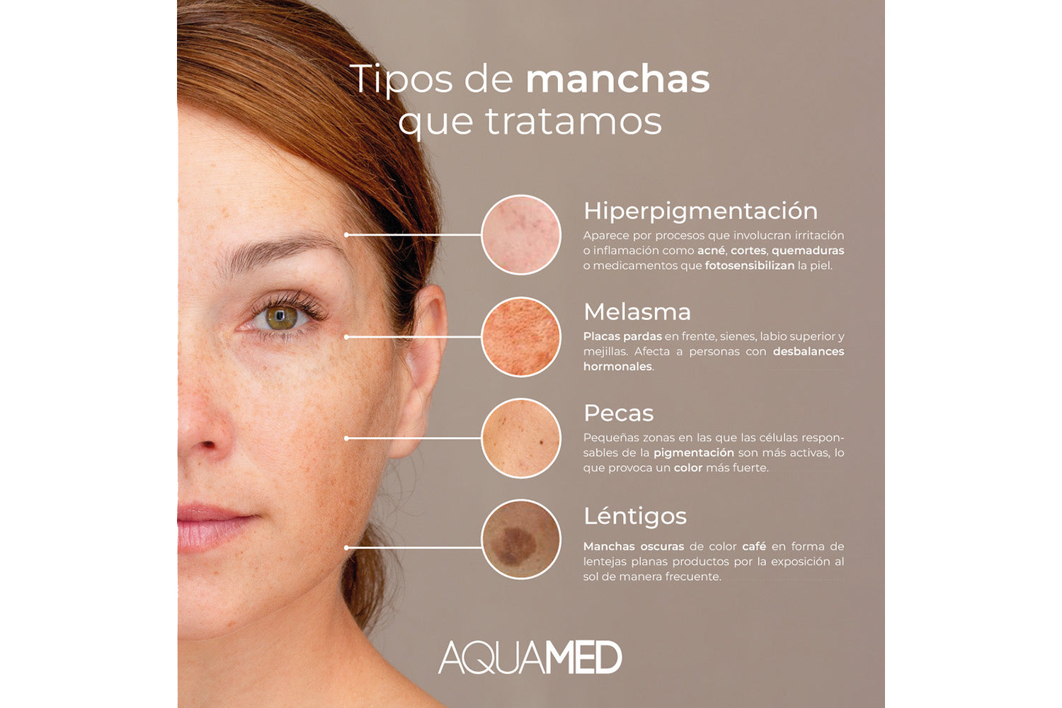 Infografía sobre los &quot;Tipos de manchas que tratamos&quot;: Hiperpigmentación, Melasma, Pecas y Léntigos. 