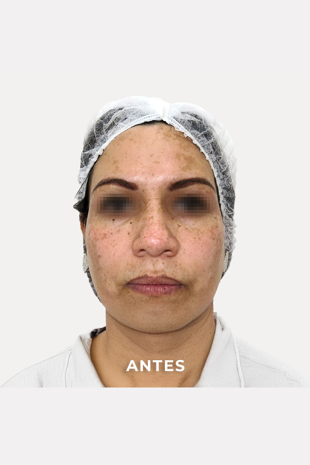 Acercamiento del rostro de una mujer. Sobre la imagen se encuentra la palabra: &quot;Antes&quot;.