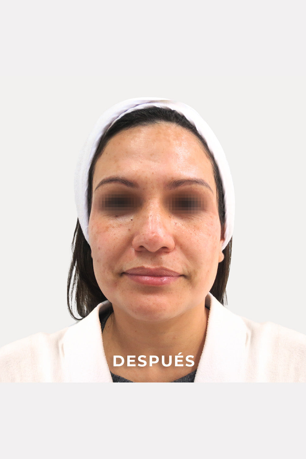 Acercamiento del rostro de una mujer. Sobre la imagen se encuentra la palabra: &quot;Después&quot;.