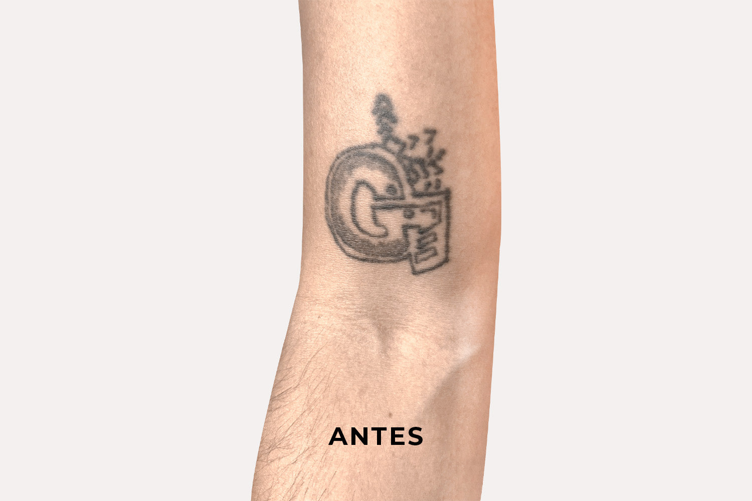 Láser Para Tatuajes - Corporales